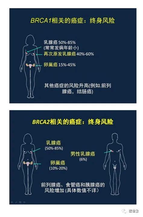 家族遗传性肿瘤 卵巢癌篇遗传性肿瘤brca1基因突变卵巢癌乳腺癌肿瘤 健康界