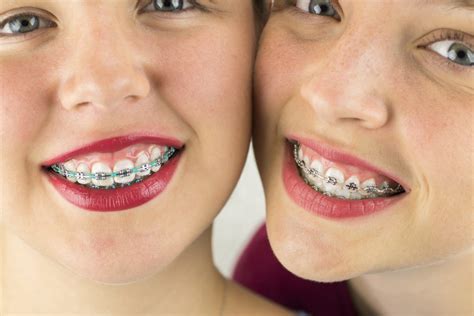 Why Braces Are a Good Back to School Accessory