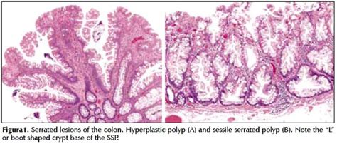 Showing 4 Serrated Polyp Subtypes A Microvesicular