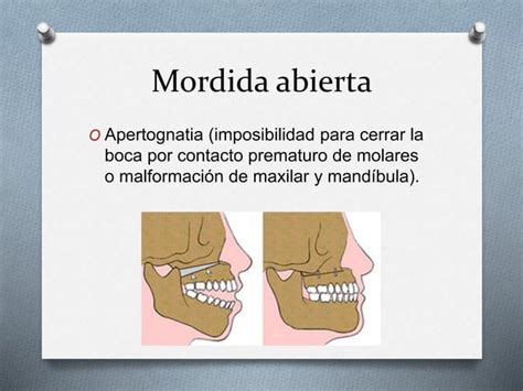 Apertognathia O Mordida Abierta Ppt