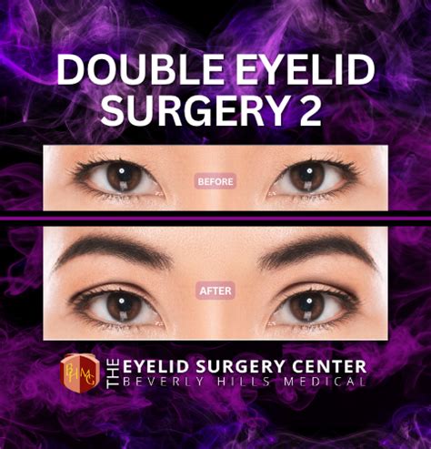 Asian Eyelid Surgery Double Eyelid Eyelid Surgery