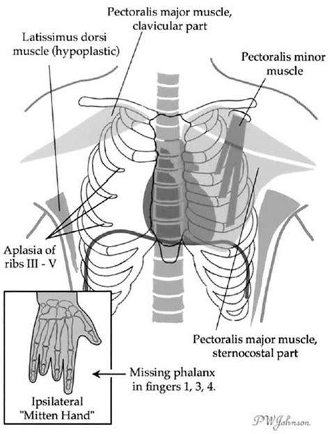 Pin on Poland Syndrome | Facts