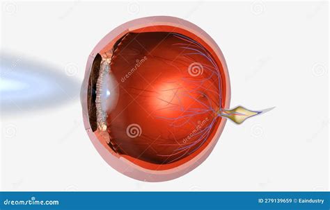 Presbyopia Is A Degenerative Eye Condition Characterized By The Stock