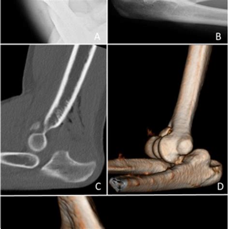 Anteroposterior A And Lateral B Plain Radiographs Of The Elbow