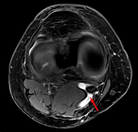 Bakers Cyst Causes Symptoms Treatment And Surgery