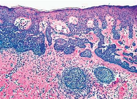 Basaloid epidermal hyperplasia over a dermatofibroma. This ...