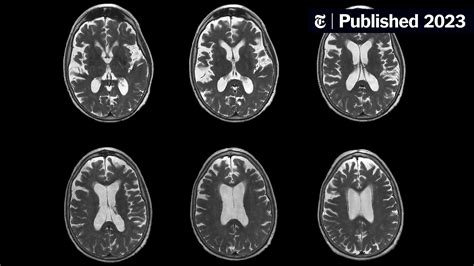 Esource Ohiohealth: Ohio's Shocking Alzheimer's Discovery: A Potential Cure?