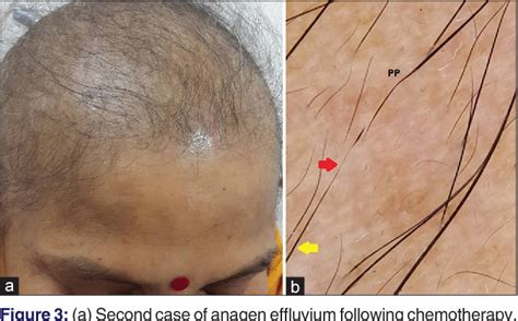 Figure 3 From Tulipoid Hair Anagen Effluvium Marker Semantic Scholar