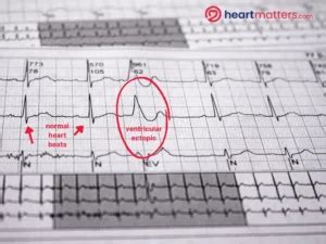 Palpitations and Ventricular Ectopics: Causes, Symptoms, and Management - Heart Matters