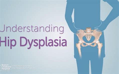 What Is Hip Dysplasia Can It Be Treated