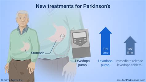 Slide Show Treatment And Management Of Parkinsons Disease