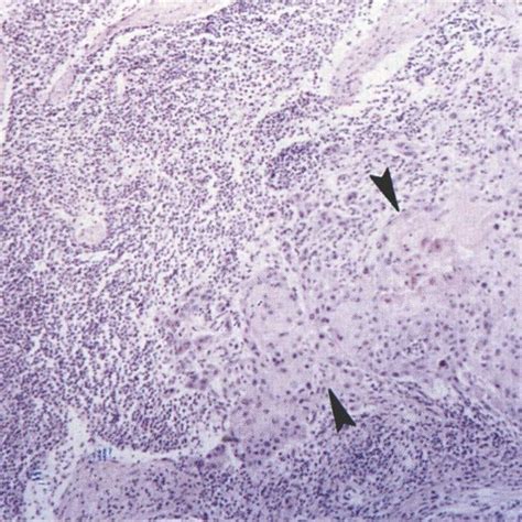 Photomicrograph Showing An Early Well Differentiated Squamous Cell