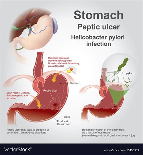 Stomach Ulcer Remedies, Stomach Ulcers Symptoms, Ulcer Symptoms ...