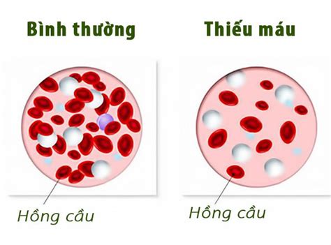 Nên ăn Gì Bổ Sung Sắt Cho Người Thiếu Máu Thiếu Sắt Vinmec