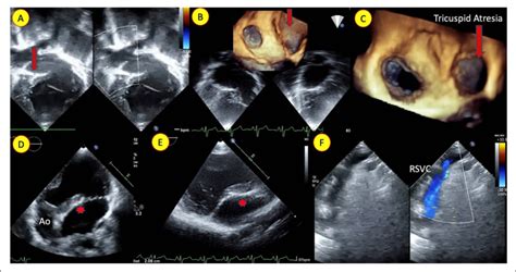 A Echocardiogram In Apical Four Chamber View With Color Doppler