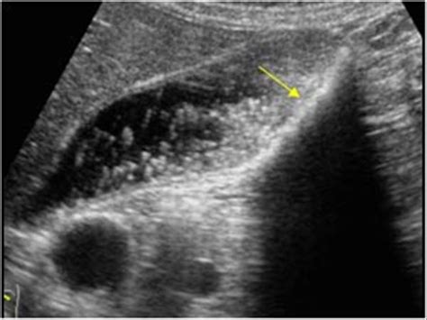 Cholesterolosis Ultrasound