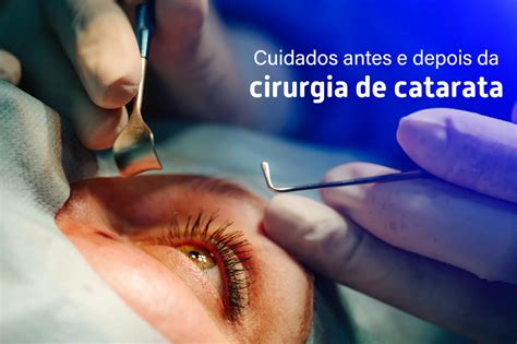 Cuidados Antes E Depois Da Cirurgia De Catarata Guia Sa De Cidades