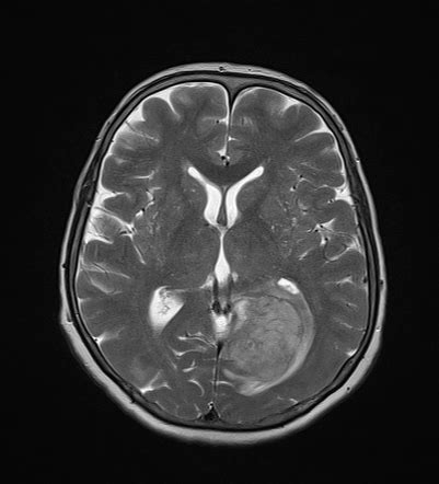 Hypertensive Intracerebral Hemorrhage Radiology Case Radiopaedia Org