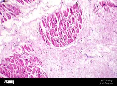 Infarctus Aigu Du Myocarde Histologie Des Tissus Cardiaques