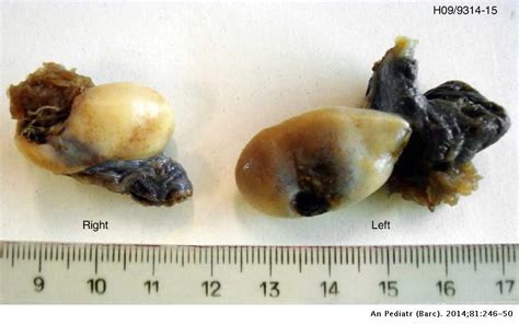 Peripheral Precocious Puberty 46xy Complete Gonadal Dysgenesis