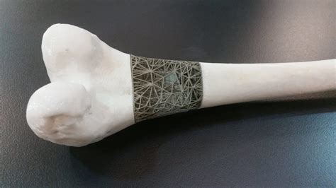 Doctors Plan To 3d Print Bone Implants Mid Surgery All3dp