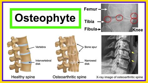 Osteophyte Youtube