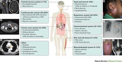 Melioidosis Nature Reviews Disease Primers