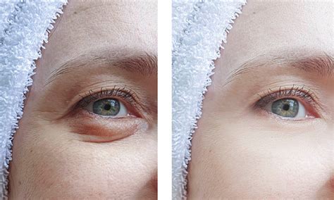 How Much Does An Eyelid Lift Cost Experts In Plastic Surgery