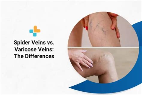 Spider Veins Vs Varicose Veins The Differences By Ayu Health Hospitals Medium