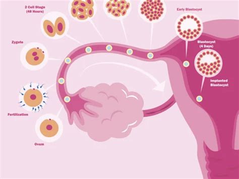 Qu Consecuencias Trae La Extirpaci N De Ovarios Salud