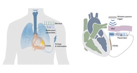 Herz Schrittmacher Und Defibrillatoren Von Elektromagnetischen Feldern