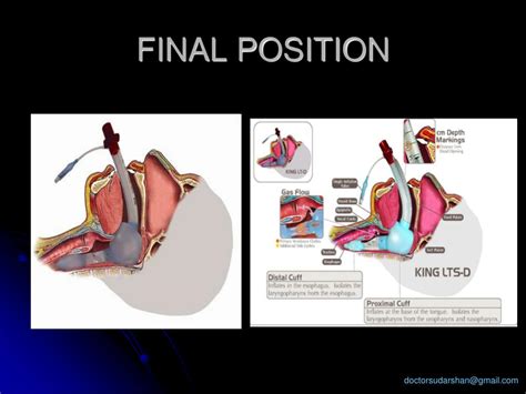 PPT Advances In Supraglottic Airway PowerPoint Presentation ID 191584