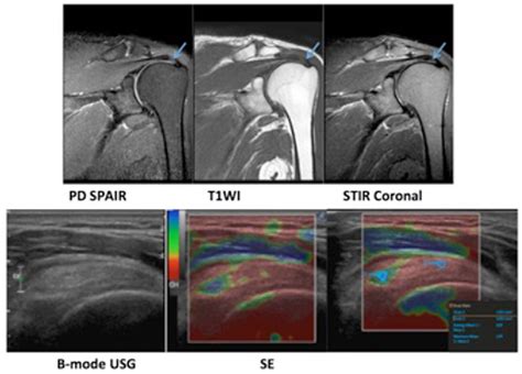 Figure 3 From The Value Of Sonoelastography In The Diagnosis Of