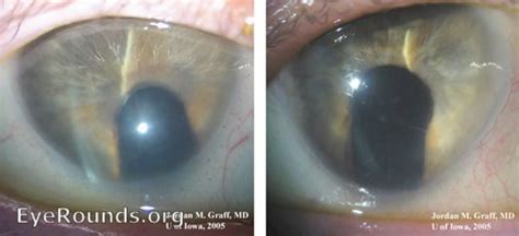 Coloboma Isolated Hereditary Ocular Diseases