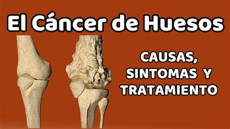 C Ncer De Huesos Causas Signos Y S Ntomas Diagn Stico Y Tratamiento