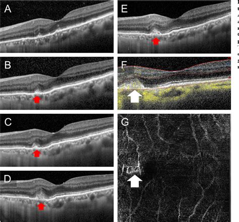 Figure 4 From A Case Of Angioid Streaks That Produced Choroidal Neovascularization After The