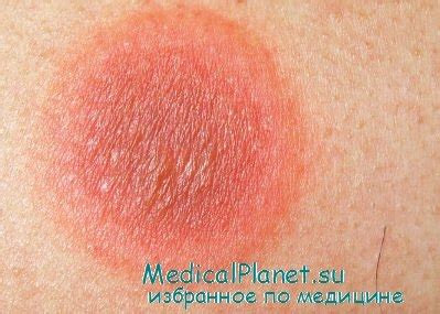 Эритема фиксированная лекарственная