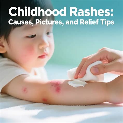 Childhood Rashes: Causes, Pictures, and Relief Tips – Parnthub: Newborn
