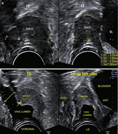 General Techniques In Gynecological Ultrasound Obgyn Key