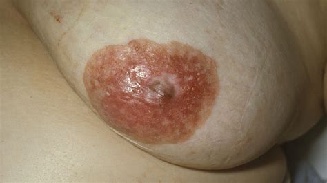 Paget’s Disease of the Breast: Symptoms, Causes, Diagnosis, and Treatment