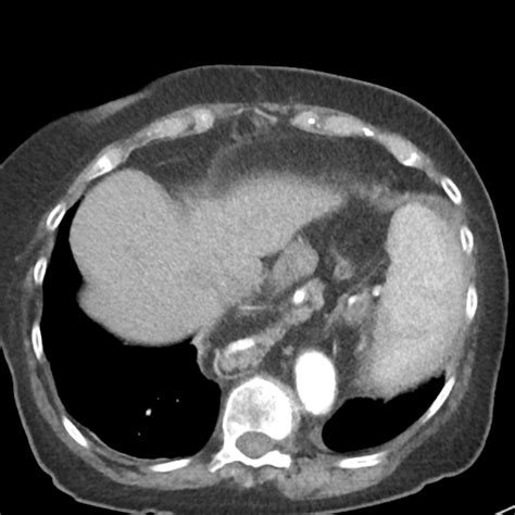 File Hiatus Hernia Containing Stomach Pancreas Splenic Flexure