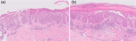 Histological Comparison Of Before A And After B Treatment A