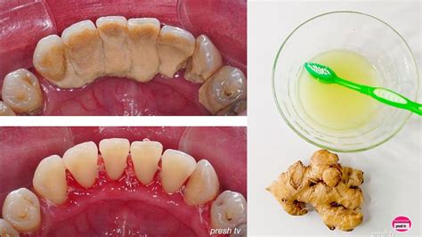 Tartar teeth – Artofit