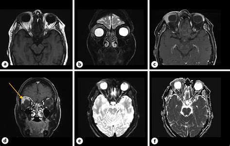 Figure From Idiopathic Granulomatous Orbital Inflammation With Right