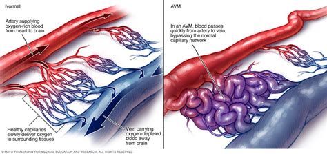 Brain Avm Arteriovenous Malformation Disease Reference Guide Drugs