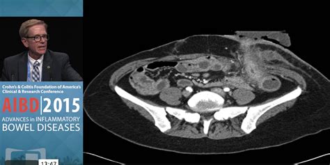 How To Manage Intra Abdominal Abscesses In Crohns Disease