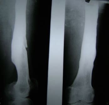 Radiograph Of Chronic Osteomyelitis Of Femur Bone And Spine