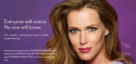 JuvÉderm® Collection Of Fillers Lift Cheeks Smooth Parentheses Lines