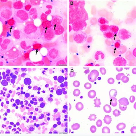 Pdf Understanding Sideroblastic Anemia An Overview Of Genetics Epidemiology Pathophysiology