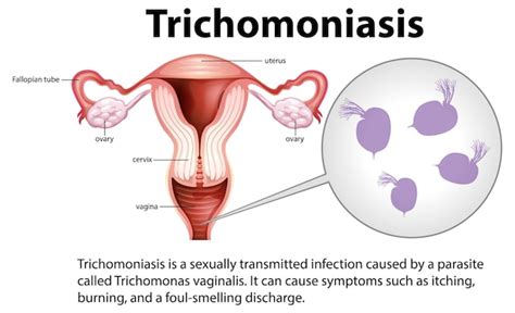 Infografía De Tricomoniasis Con Explicación Vector Gratis